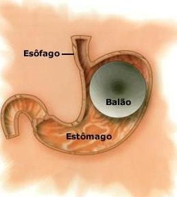 imagem da localizao do esfago e do estomgo, quando comparados a um balo intra gstrico