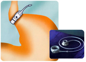 imagem que mostra uma prtese de silicone na entrada do estmago conectada a um portal implantado abaixo da pele do abdome