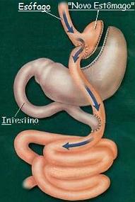 omagem de uma cirurgia com um corte numa pequena parte do estmago (a mais alta) onde se cria uma pequena bolsa que ser o novo estmago
